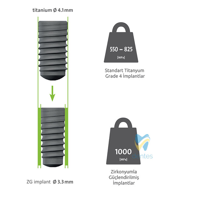 Zirkonyum ile Güçlendirilmiş İmplantlar