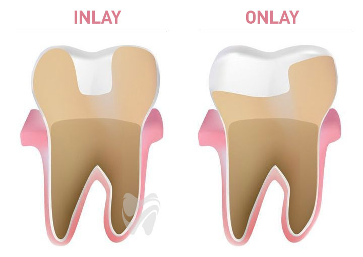 Dijital Inlay / Onlay Dolgular