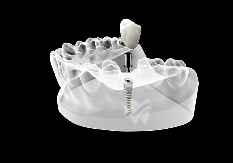 Anında İmplant (Immediate Implant) Nedir?